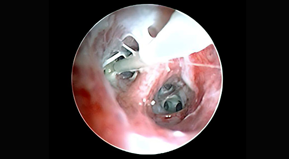 Aerosol drug delivery